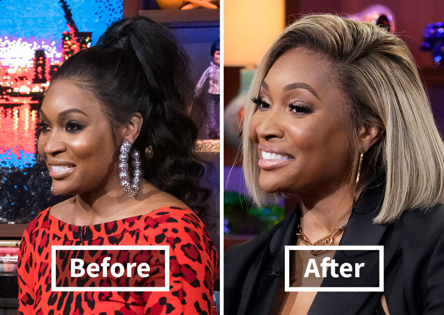 transplantácia vlasov