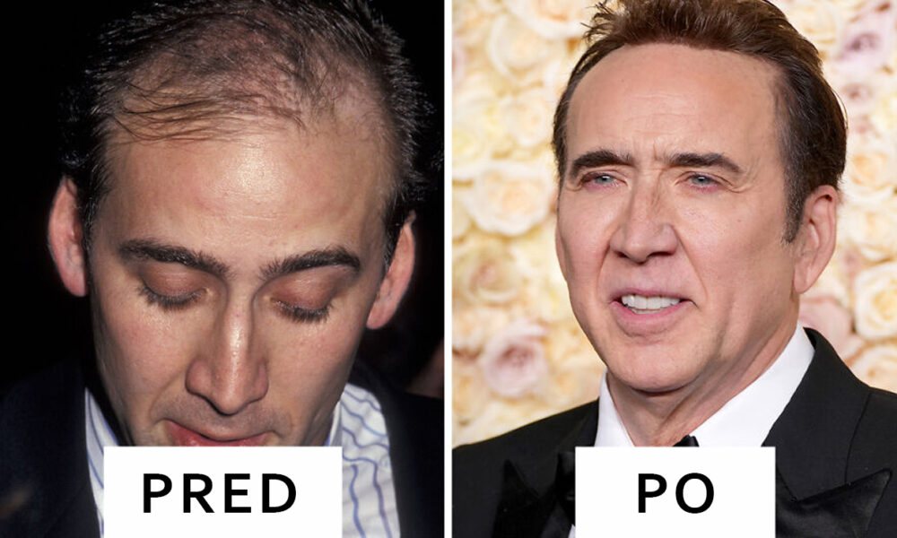 transplantácia vlasov